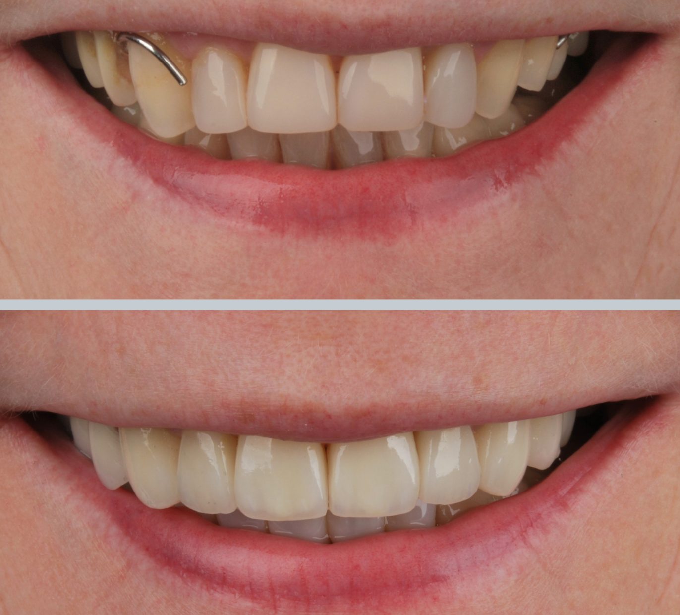Keramikinės dantų laminatės prieš ir po gydymo