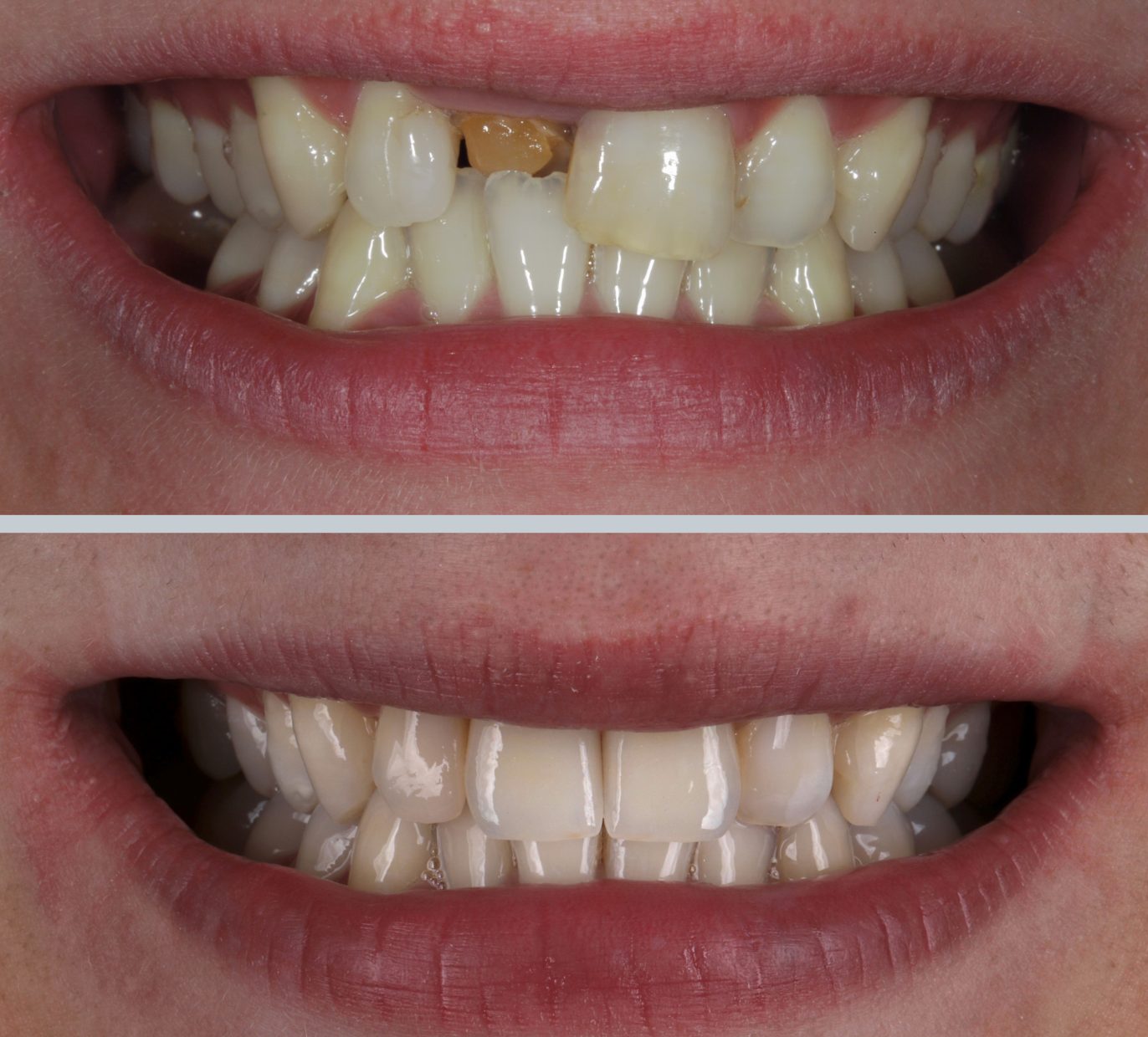 Pažeisto danties atkūrimas vainikėliu prieš ir po gydymo