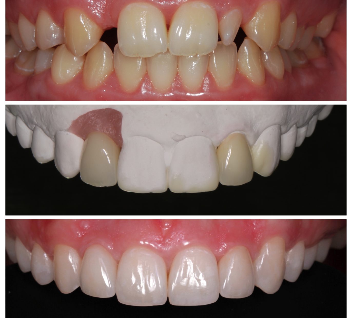 Priekinių dantų atkūrimas trimis etapais prieš ir po gydymo