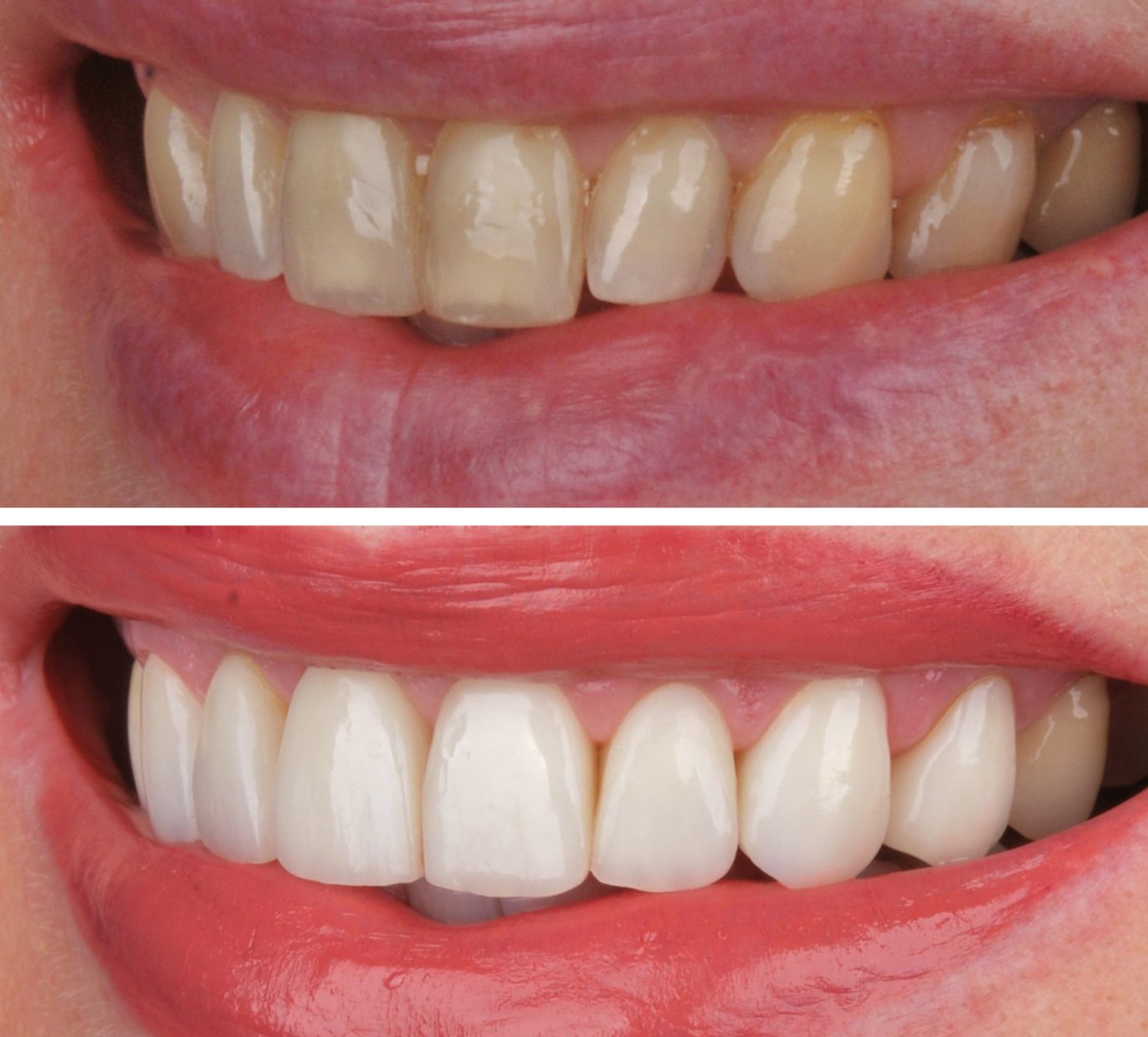 Tetraciklininiai dantys prieš ir po gydymo dantų laminatėmis