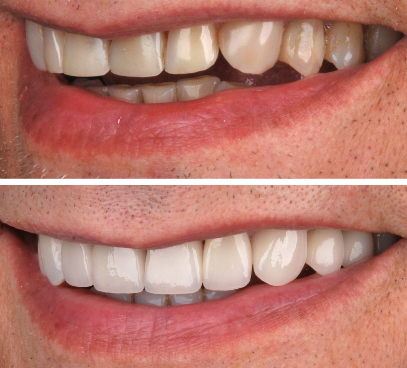 Vyriška šypsena prieš ir po dantų laminates dantų tiltą ir estetinį plombavimą