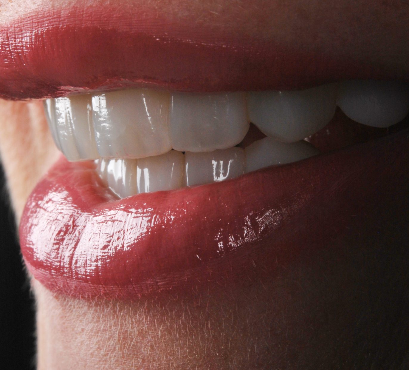 Moters dantys ir jiems atliktas estetinis plombavimas