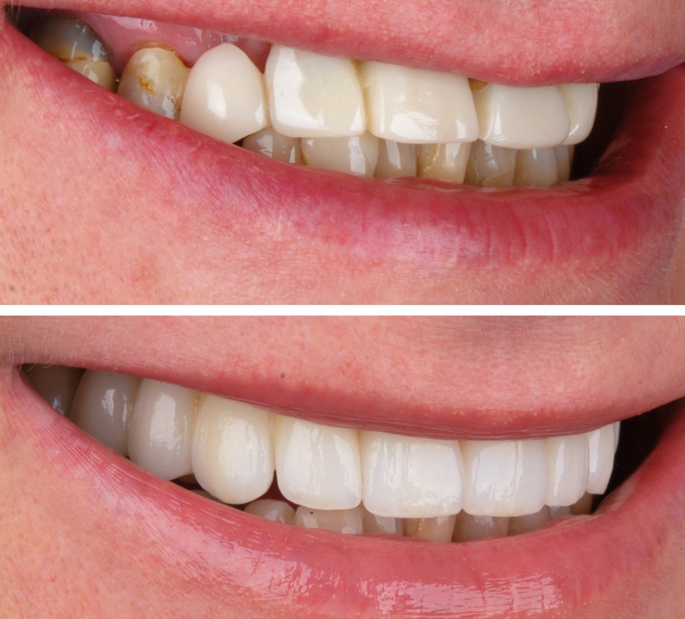 Šypsena prieš sinuso pakėlimo operaciją ir dantų protezavimą ir po jo