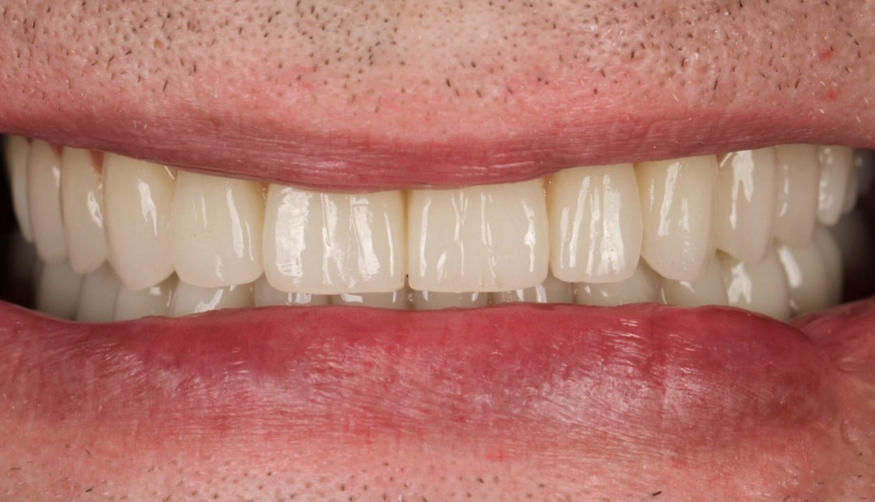 Dantų implantai ir protezai po gydymo