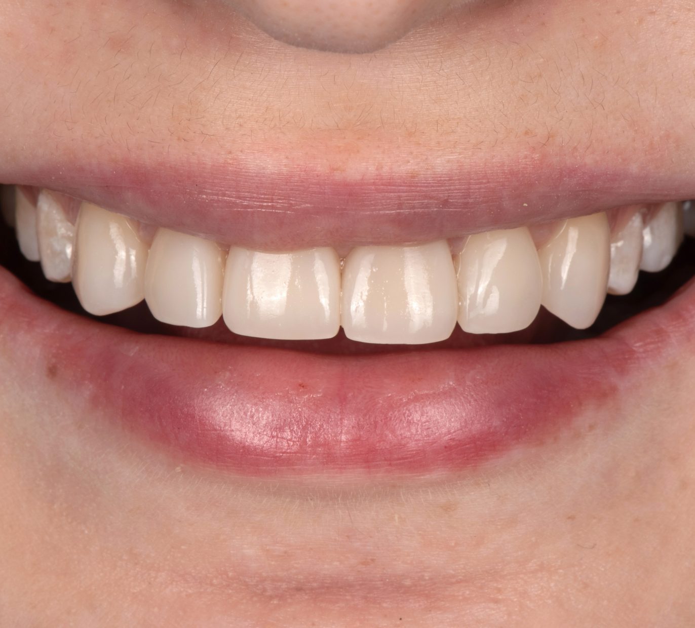 Estetinis plombavimas ant moters priekinių dantų