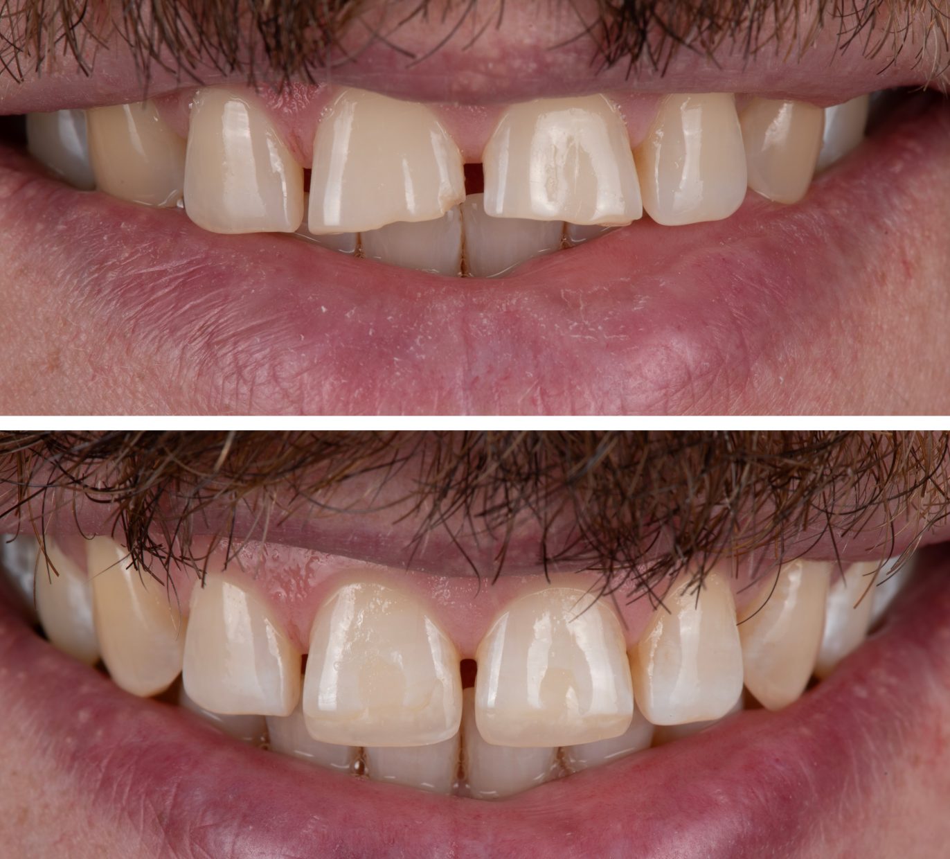 Estetinis plombavimas po dantų traumos