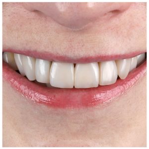 Estetinis plombavimas po 3 metų