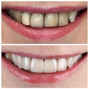 Priekinių dantų estetinis plombavimas prieš ir po