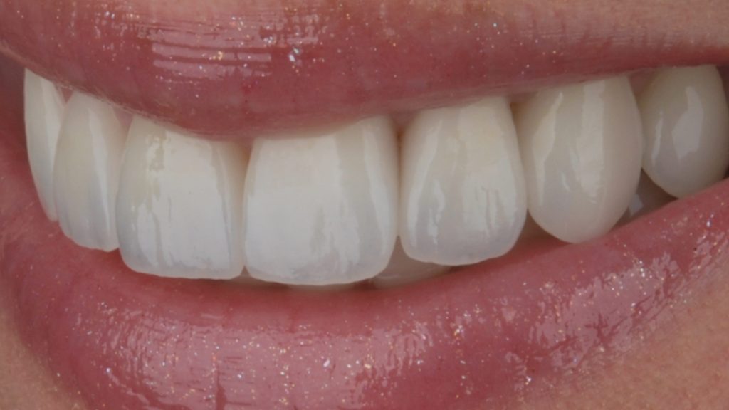 Dantų laminatės venyrai