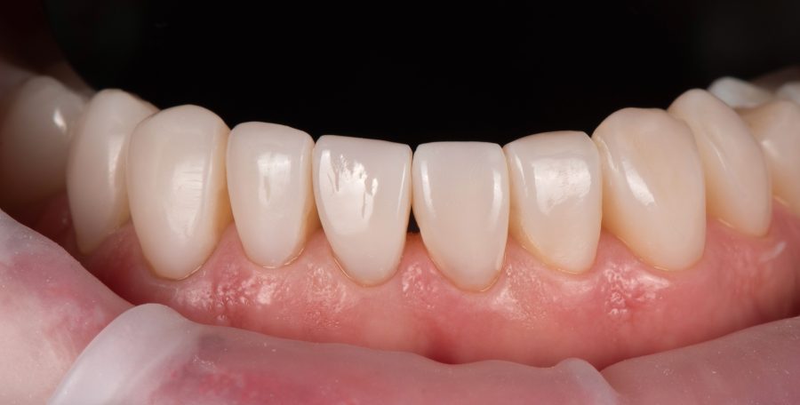 Apatiniai dantys po plombavimo