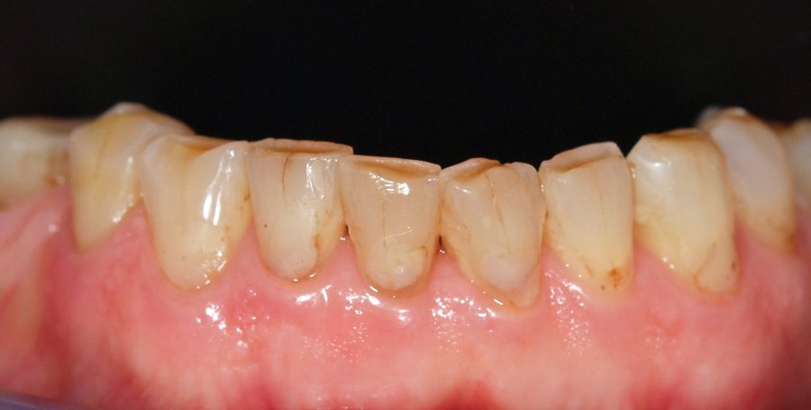 Apatiniai dantys prieš plombavimą