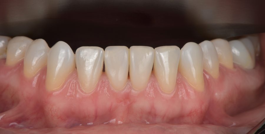 Apatiniai priekinių dantys po plombavimo