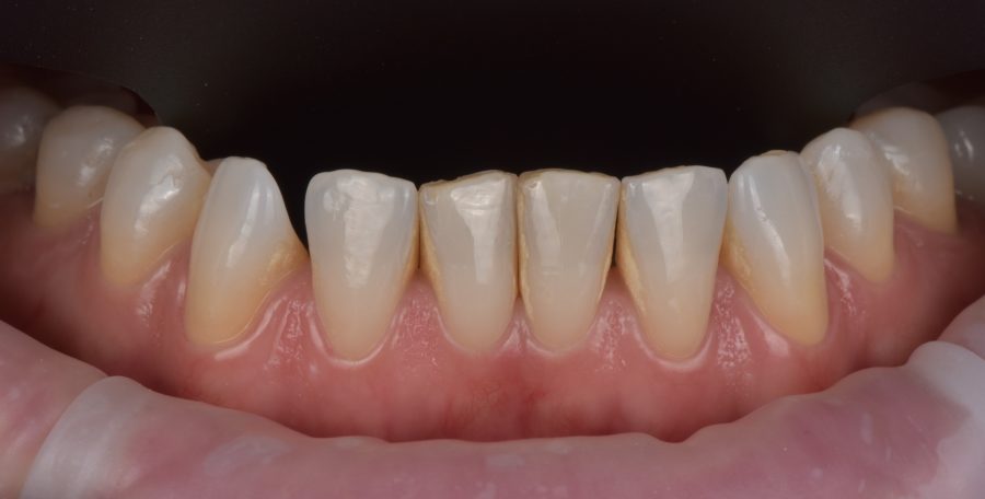 Apatiniai priekiniai dantys prieš plombavimą