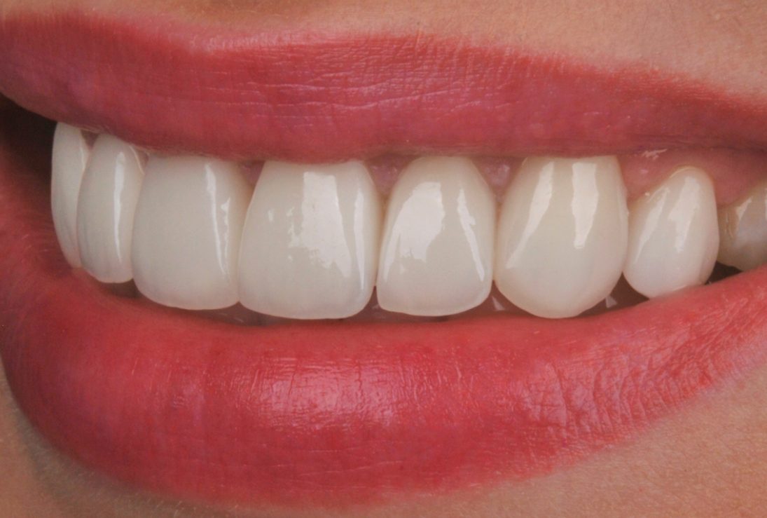 Dantų laminatės po 3 metų