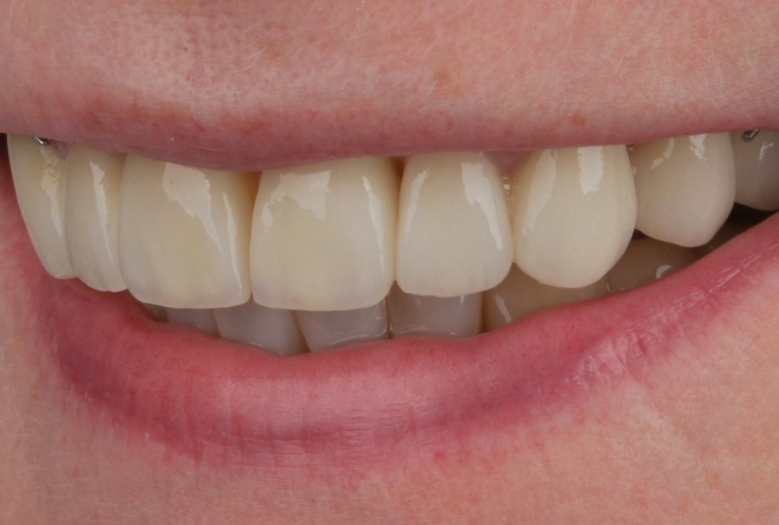 Dantų plokštelė ir dantų laminatės prieš ir po