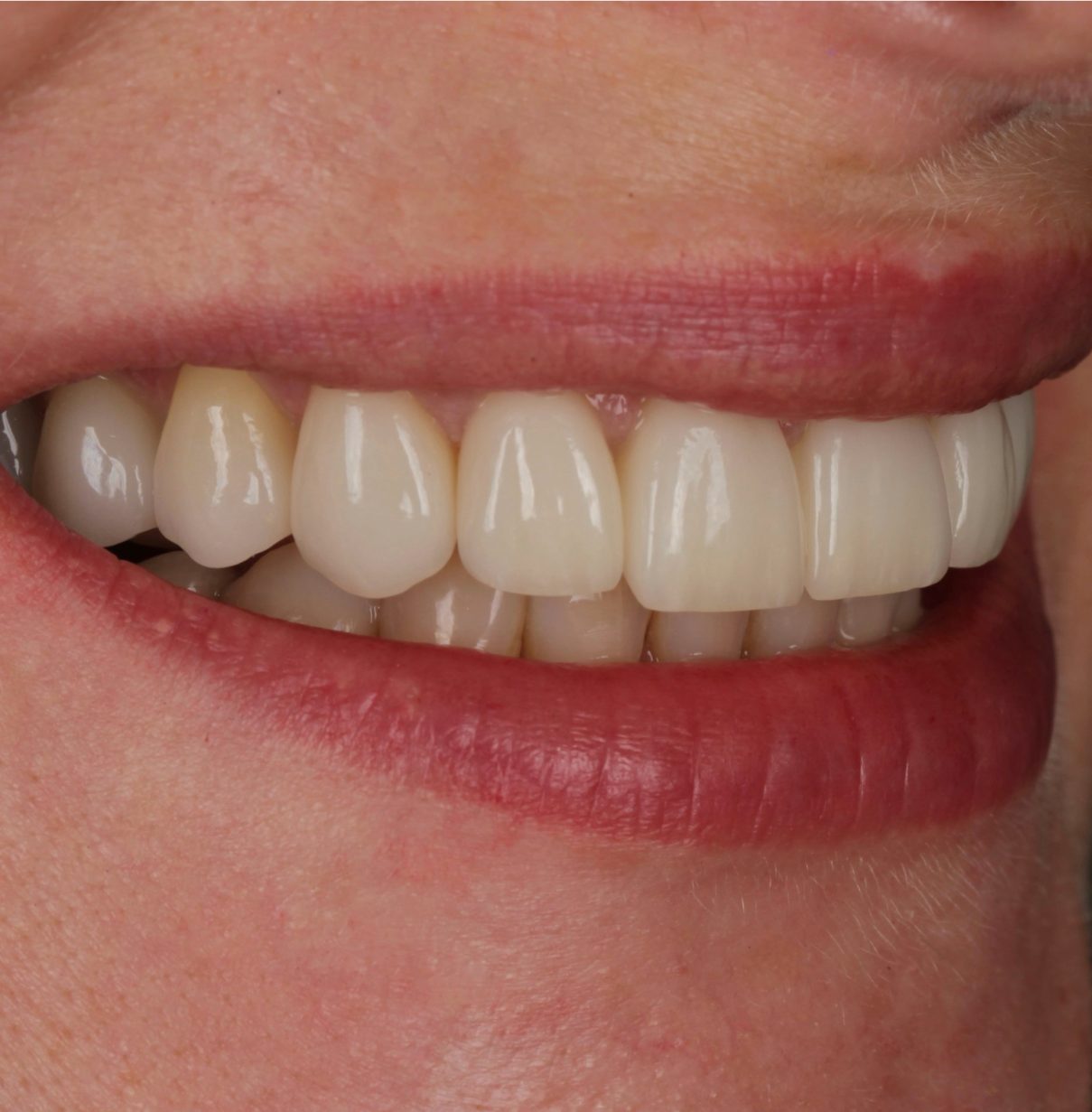 Laminatės ir karūnėlės ant pacientės dantų