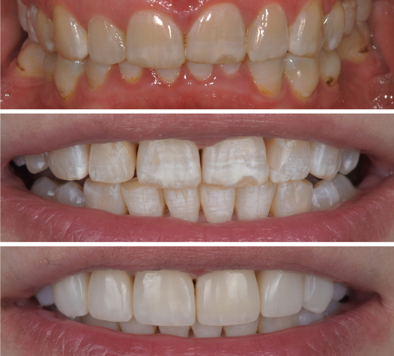 Pacientės dantys prieš ir po gydymo kapomis