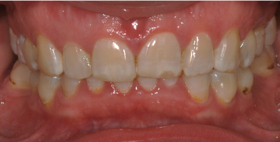 Dantys prieš tiesinimą kapomis