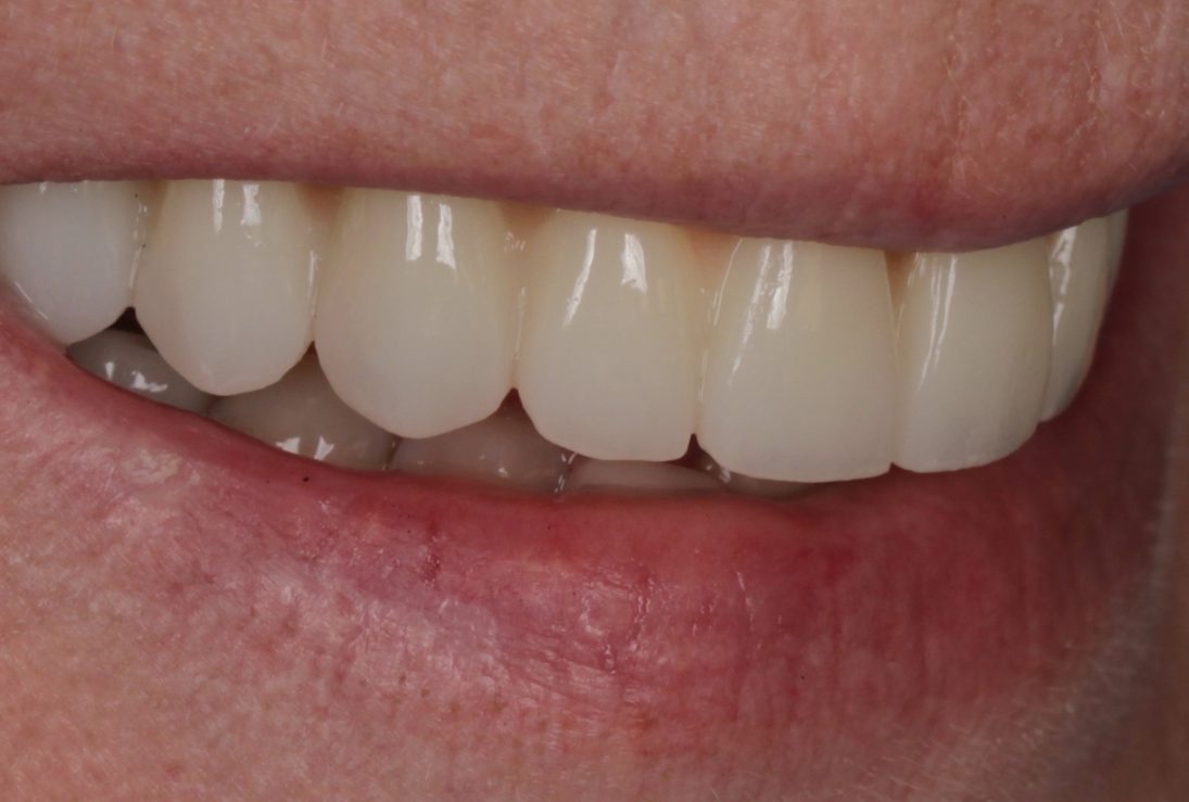 Visų dantų protezai ant 4 implantų