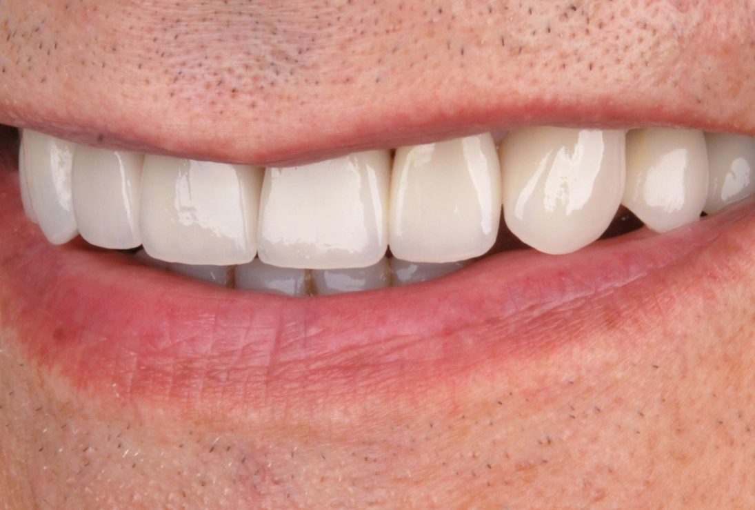 Vyro šypsena su dantų laminatėmus